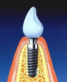 Οδοντική επεξεργασία χωρίς πόνο. Dental care.